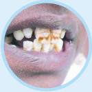Dental Fluorosis